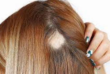 Alopecia